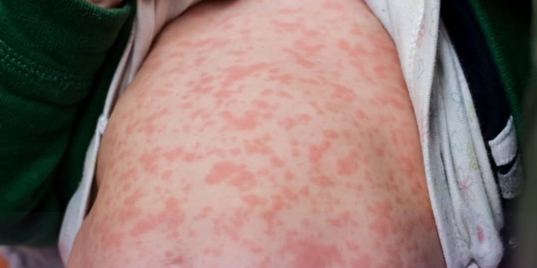 Dinkes Temukan 30 Anak Positif Campak di Tasikmalaya