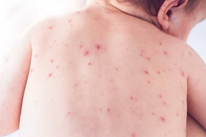 Kasus Campak Naik Jelang Mudik, Pakar Imbau Masyarakat tak Panik