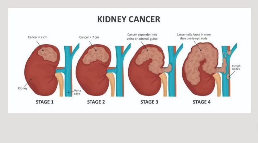 Yuk, Kenali Gejala Kanker Ginjal Sejak Dini